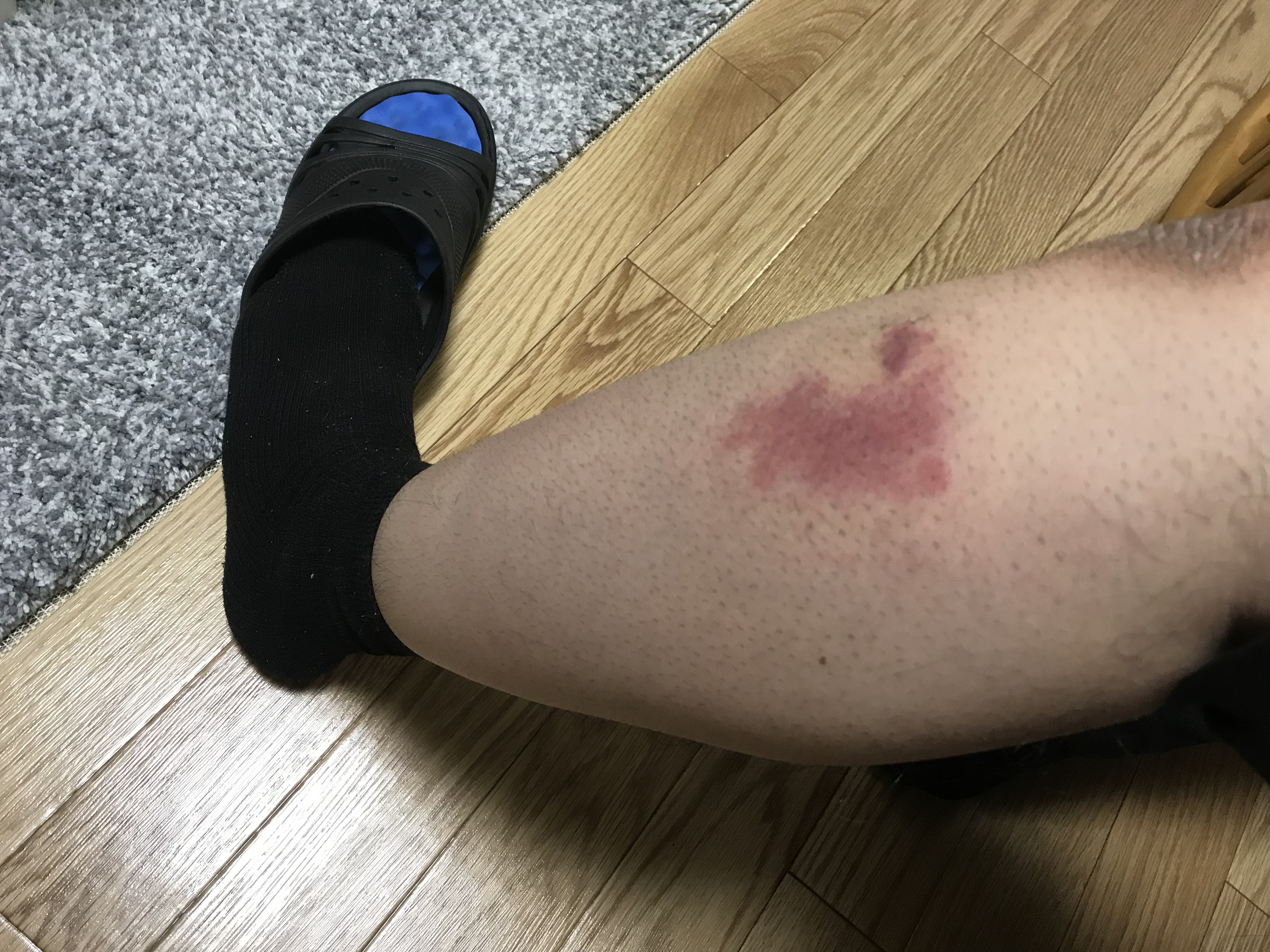 蜂刺されが心配なとき